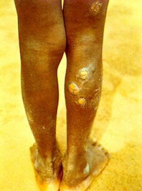 Early ulceropapillomatous yaws on the leg (from Pe
