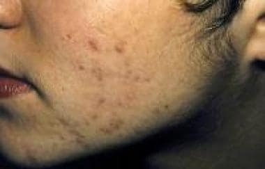 The photograph depicts hirsutism in a young woman 