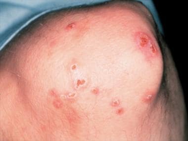 Magnified view of papules and nodules with central