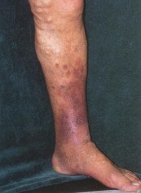 Patient with large tortuous varicose veins, high-v