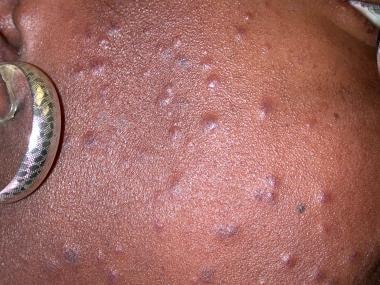 Papules and nodules on the face of an African Amer