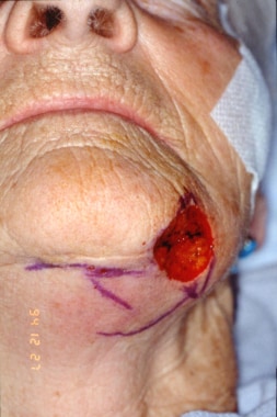 Postoperative Mohs surgical defect over the left c