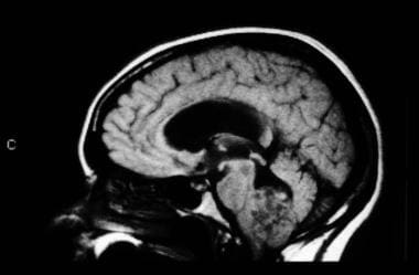 MRI, T1-weighted image, without contrast, sagittal
