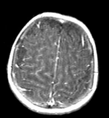 T1-weighted MRI of brain demonstrates diffuse enha