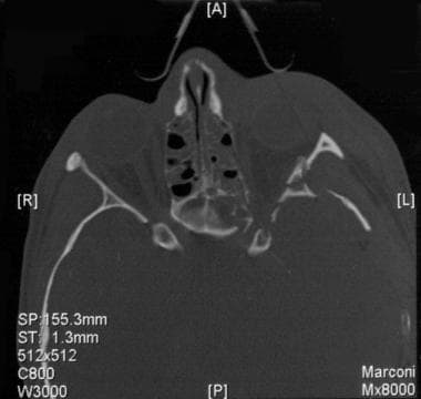 Axial CT scan exhibiting a left apex fracture thro