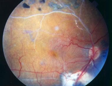 Patient with a branch retinal vein occlusion compl
