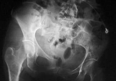 Pelvic instability