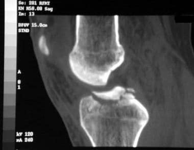 intercondylar fossa x ray