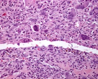 Photomicrograph of giant cell tumor with intravasc
