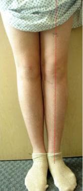 The patient's legs are straight 11 months followin