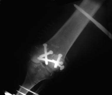 Supracondylar femur fracture treated with external