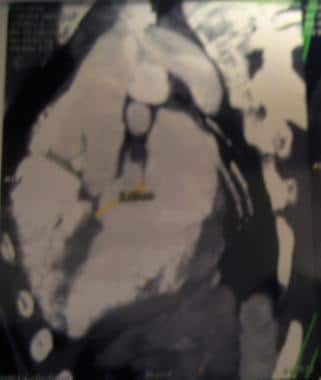Post-Rastelli repair with left ventricle to aortic