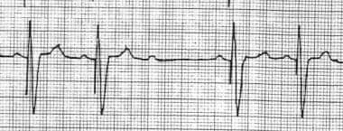 Pacemaker Malfunction. This is a typical example o