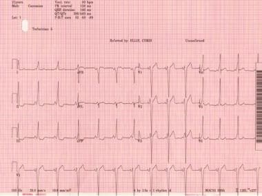 Classic Wolff-Parkinson-White electrocardiogram wi