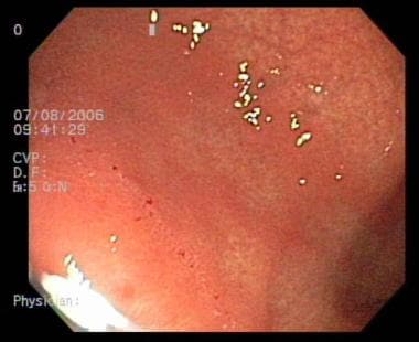 Acute Gastritis. This image reveals mucosal erythe