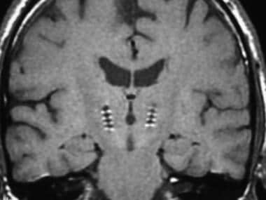 Postoperative coronal magnetic resonance image (MR