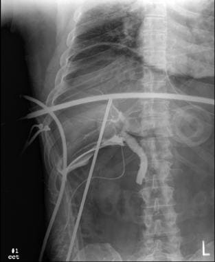 Bile Duct Strictures Workup: Laboratory Studies, Imaging Studies