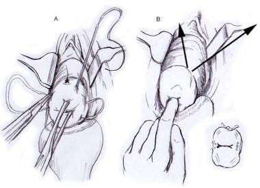 Cervical Insufficiency Treatment & Management: Cervical Cerclage