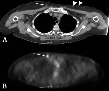 Positron emission tomography (PET) CT in an 80-yea