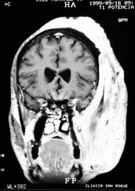 MRI coronal section of mycetoma in a 47-year-old s