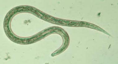 aszcariasis enterobiosis hookworm necatorosis trichocephalosis ascaris a hólyagban