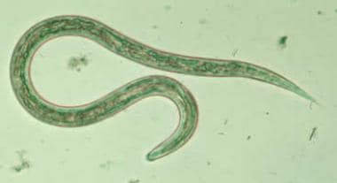 Aszcariasis trichocephalosis enterobiosis hookworm és necatorosis