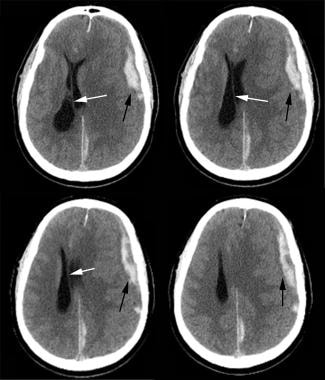 CT scan of left frontal acute epidural hematoma (b