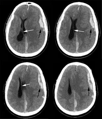 Closed Head Injury Practice Essentials Pathophysiology Epidemiology