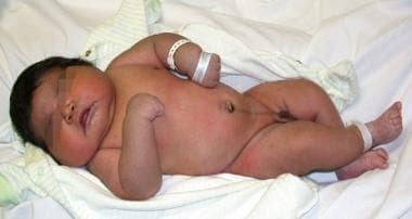 Photograph of a macrosomic newborn soon after birt