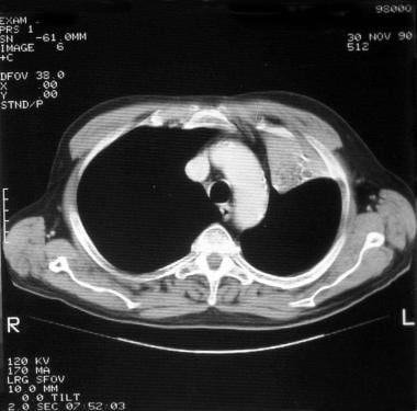 atelectasis ct workup scan lobe upper left