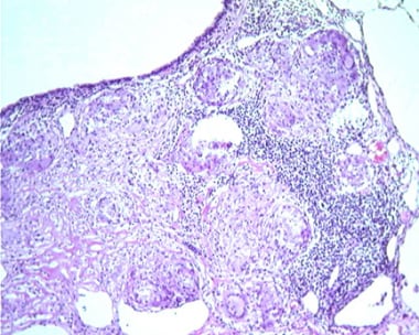 Multiple well-formed noncaseating granulomas secon
