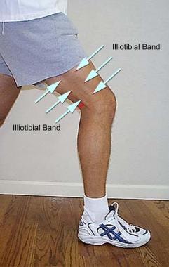 Iliotibial band noted prominently along the latera