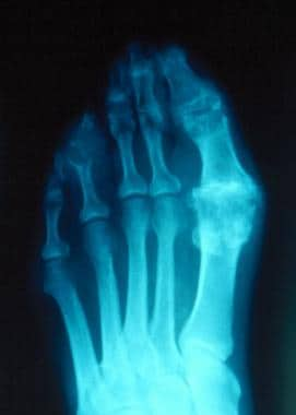 Gout. Plain radiograph showing typical changes of 