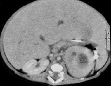 CT scan in a 2-week-old boy noted to have an abdom