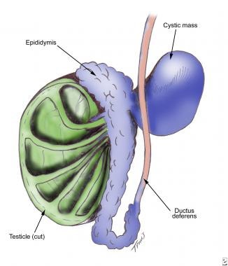 Diagram of a spermatocele. 