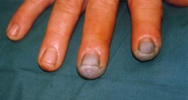 3级氢氟酸(HF)烧伤手指