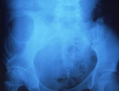 Plain radiograph of the pelvis showing a large lyt