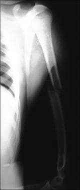 Diaphyseal humerus fracture. 