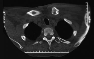 CT scan of a left sternoclavicular dislocation dem