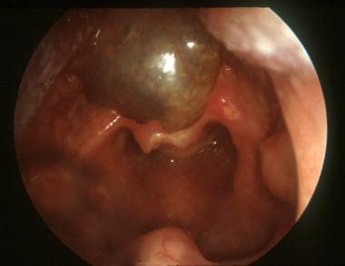 Base of tongue thyroglossal duct cyst in infant pr