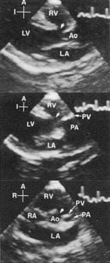Ventricular Septal Defects. Supracristal ventricul