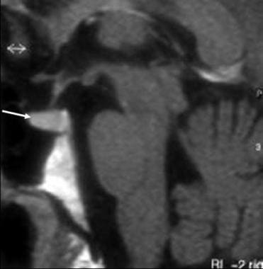 经垂体fos的t1加权矢状位MRI