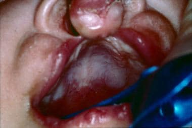Intraoral view of cleft lip and cleft palate in an