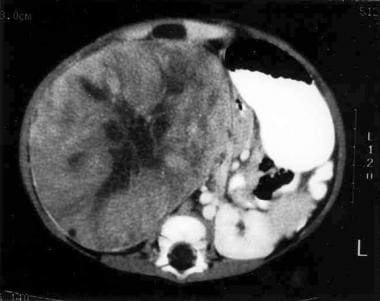 Large right-sided heterogeneous renal mass in a 9-