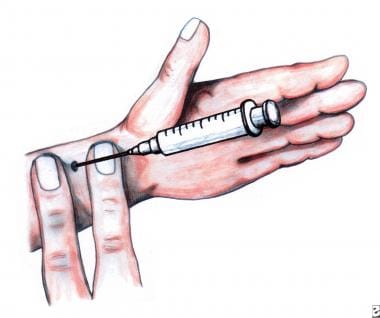Arterial cannulation of radial artery. Two fingers