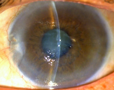 corneal guttata retroillumination