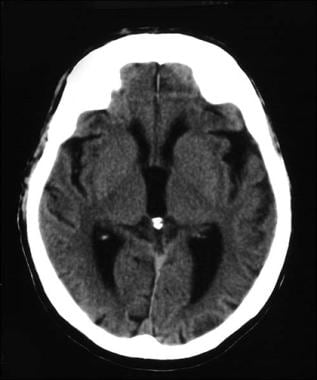 CT scan of a 62-year-old man with Down syndrome co