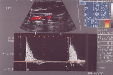 External carotid artery as seen on spectral analys