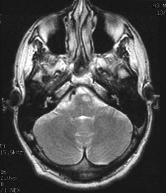 Magnetic resonance imaging showing a cryptococcoma
