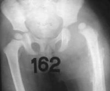 Third radiograph in series of septic left hip. Thr